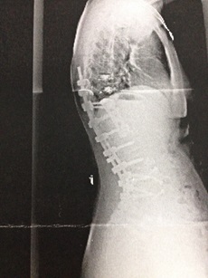 spine surgery xray